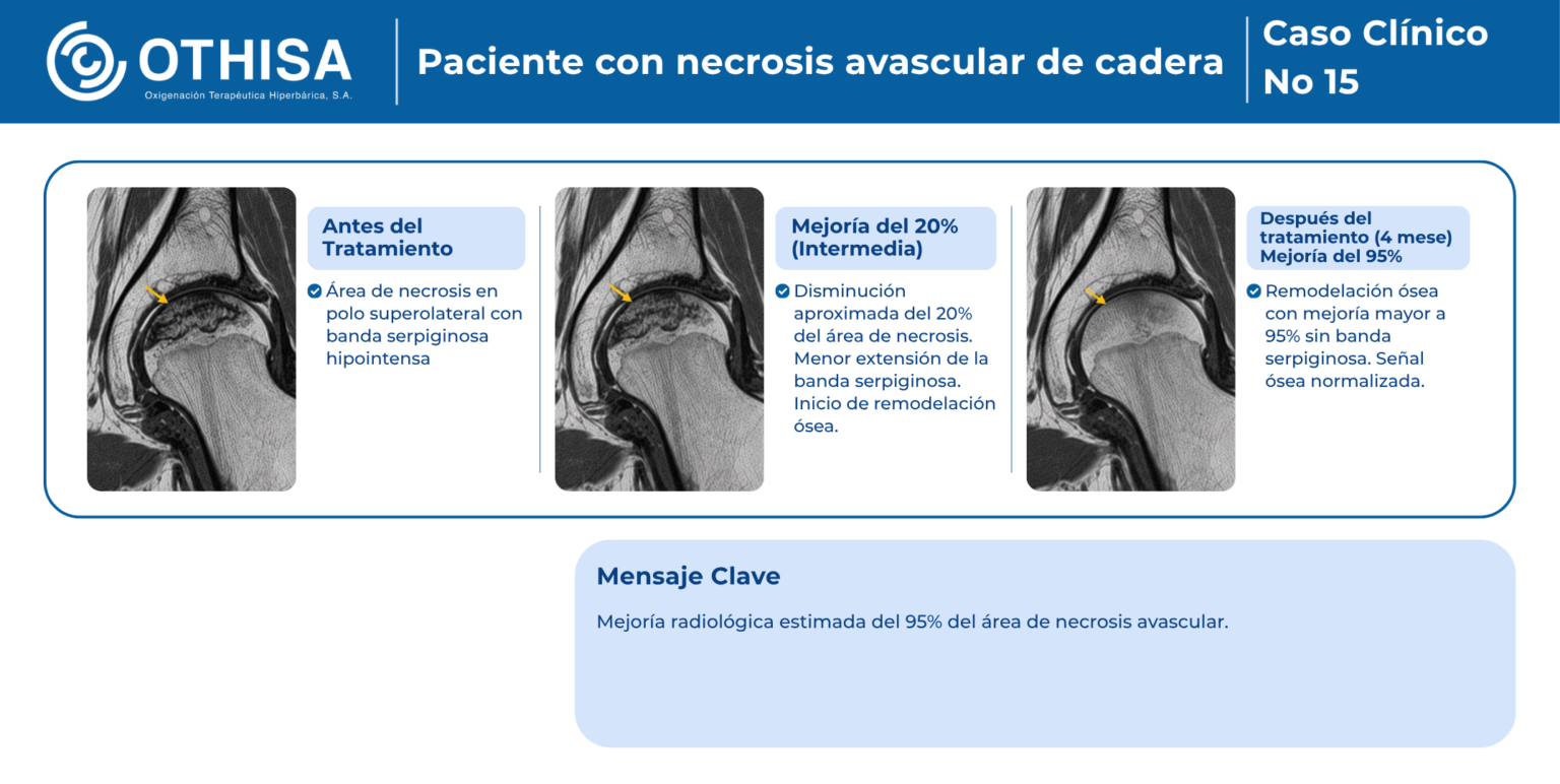 Caso Clínico 15 Paciente con necrosis avascular de cadera