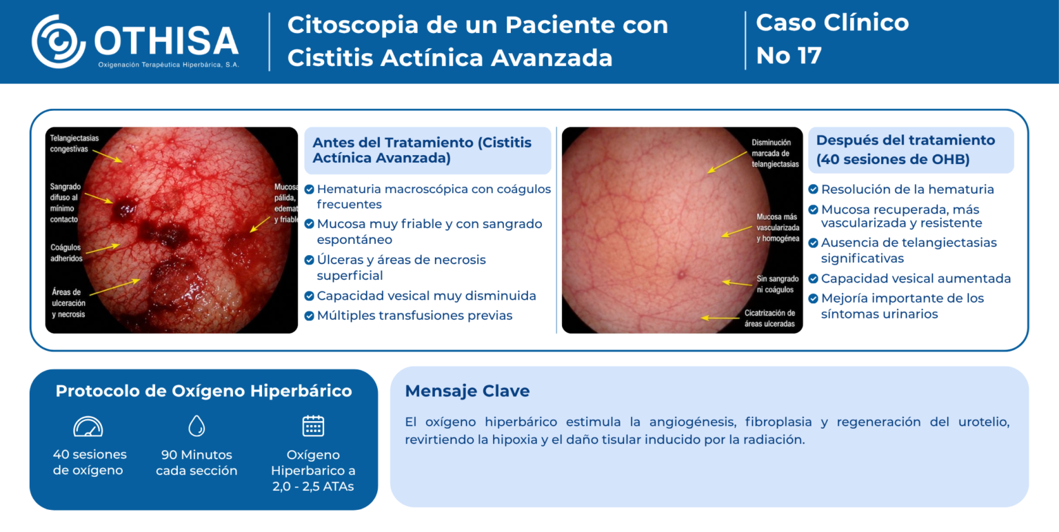 Caso Clínico 17 Citoscopia de un Paciente con Cistitis Actínica Avanzada