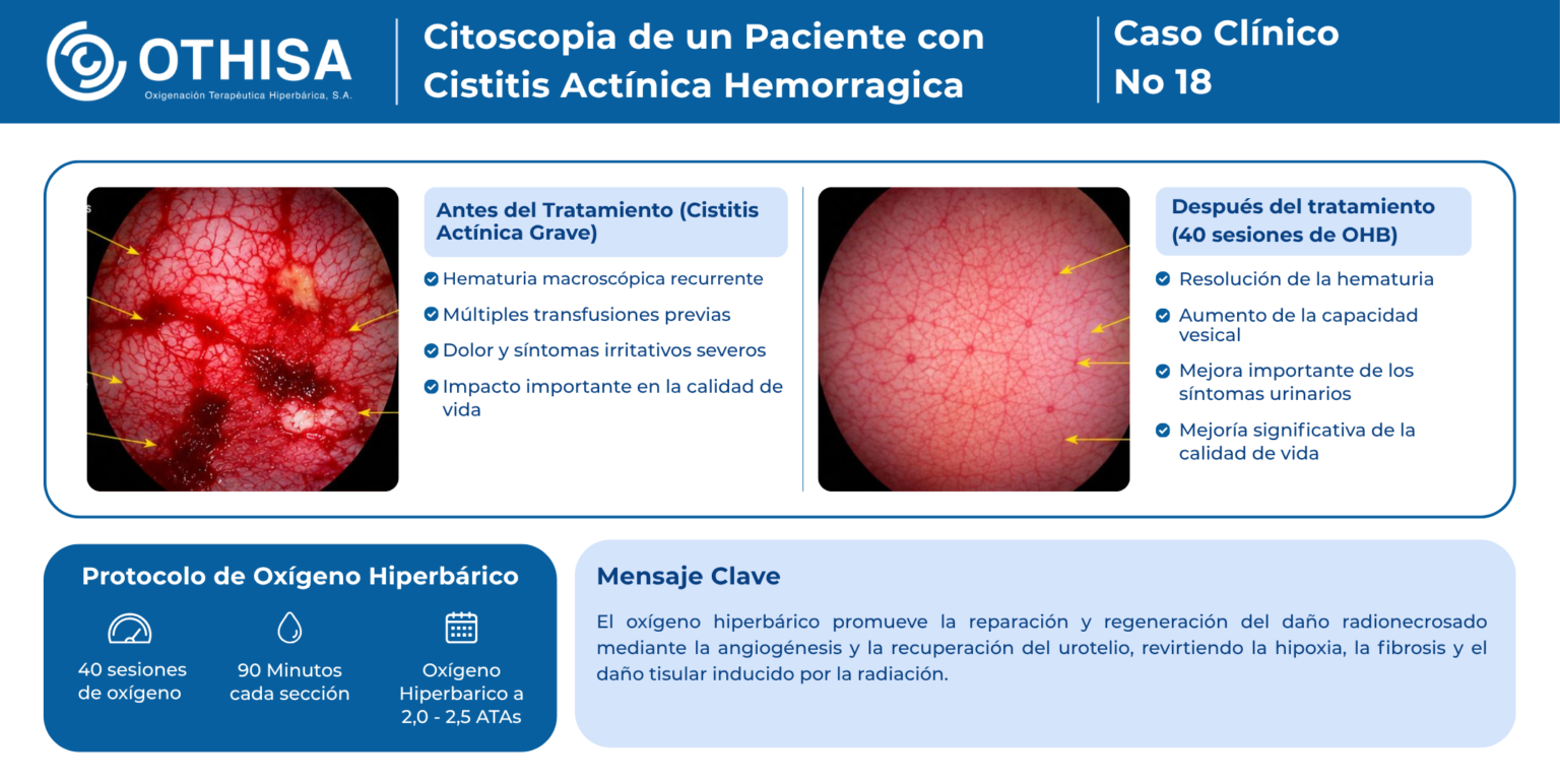 Caso Clínico 18 Citoscopia de un Paciente con Cistitis Actínica Hemorragica