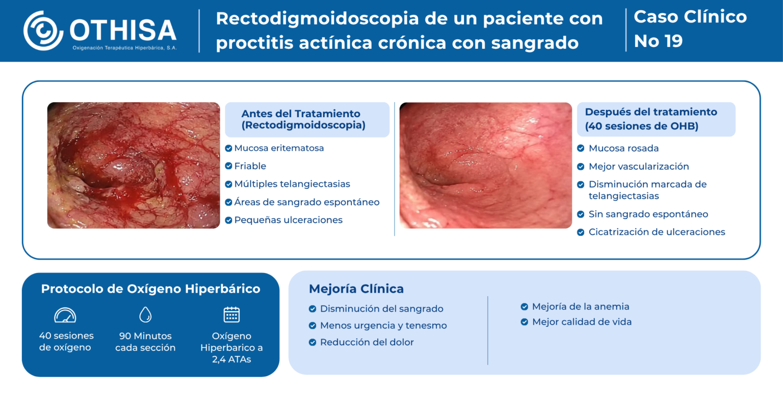 Caso Clínico 19 Rectodigmoidoscopia de un paciente con proctitis actínica crónica con sangrado