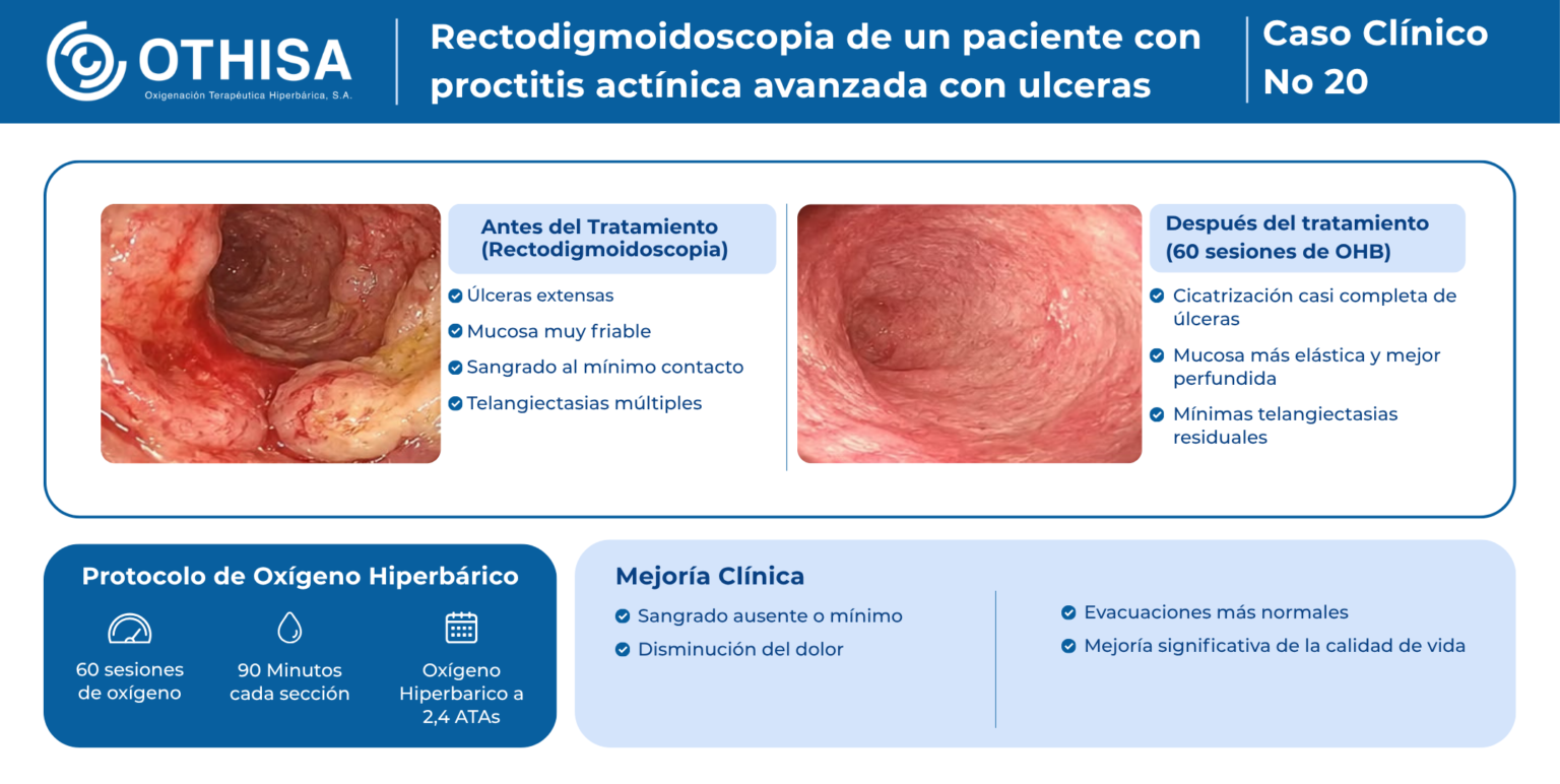 Caso Clínico 20 Rectodigmoidoscopia de un paciente con proctitis actínica avanzada con ulceras