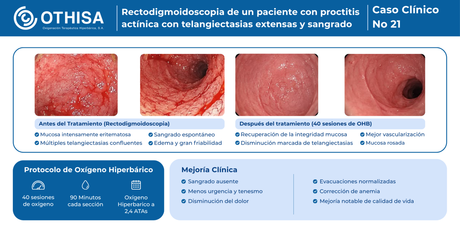 Caso Clínico 21 Rectodigmoidoscopia de un paciente con proctitis actínica con telangiectasias extensas y sangrado