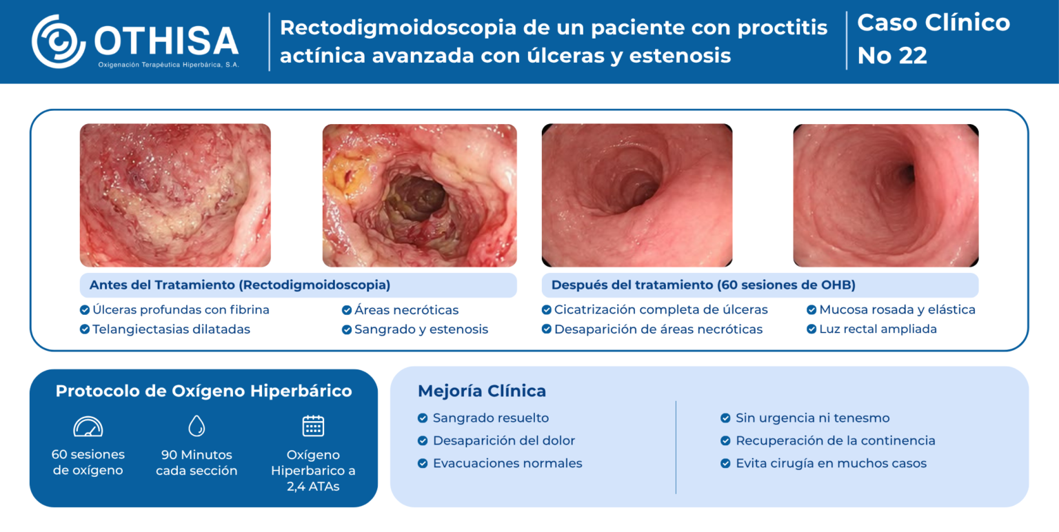 Caso Clínico 22 Rectodigmoidoscopia de un paciente con proctitis actínica avanzada con úlceras y estenosis