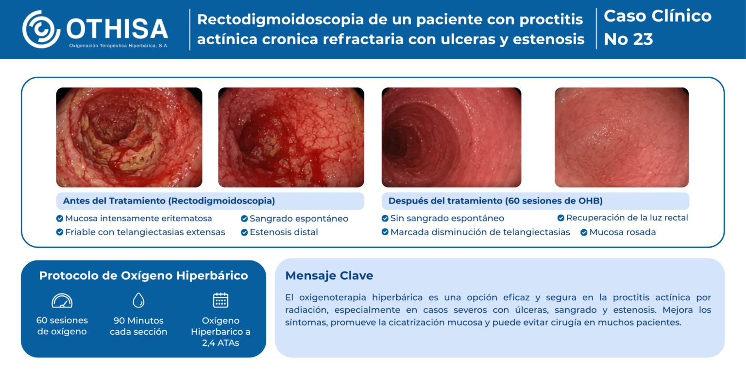 Caso Clínico 23 Rectodigmoidoscopia de un paciente con proctitis actínica cronica refractaria con ulceras y estenosis
