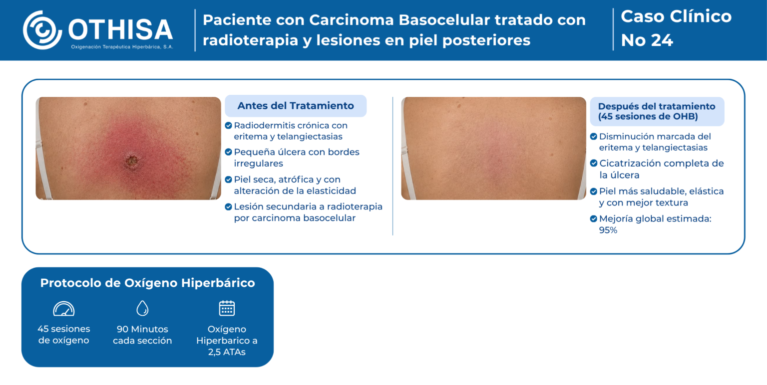 Caso Clínico 24 Paciente con Carcinoma Basocelular tratado con radioterapia y lesiones en piel posteriores