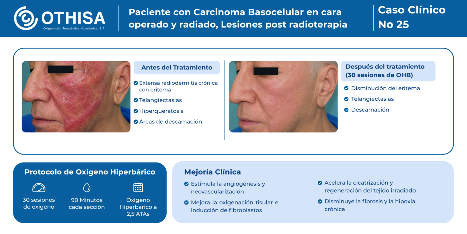 Caso Clínico 25 Paciente con Carcinoma Basocelular en cara operado y radiado, Lesiones post radioterapia