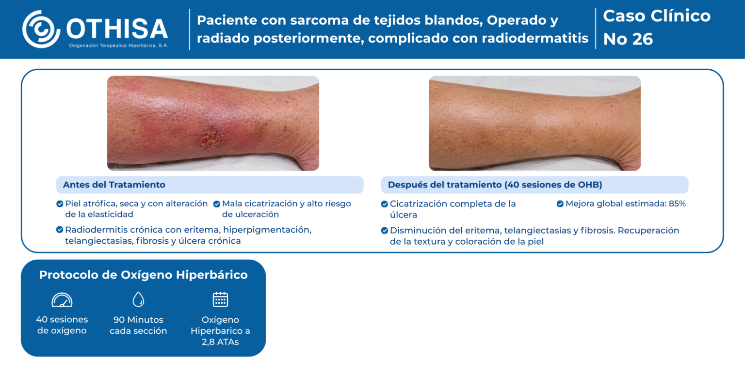 Caso Clínico 26 Paciente con sarcoma de tejidos blandos, Operado y radiado posteriormente, complicado con radiodermatitis