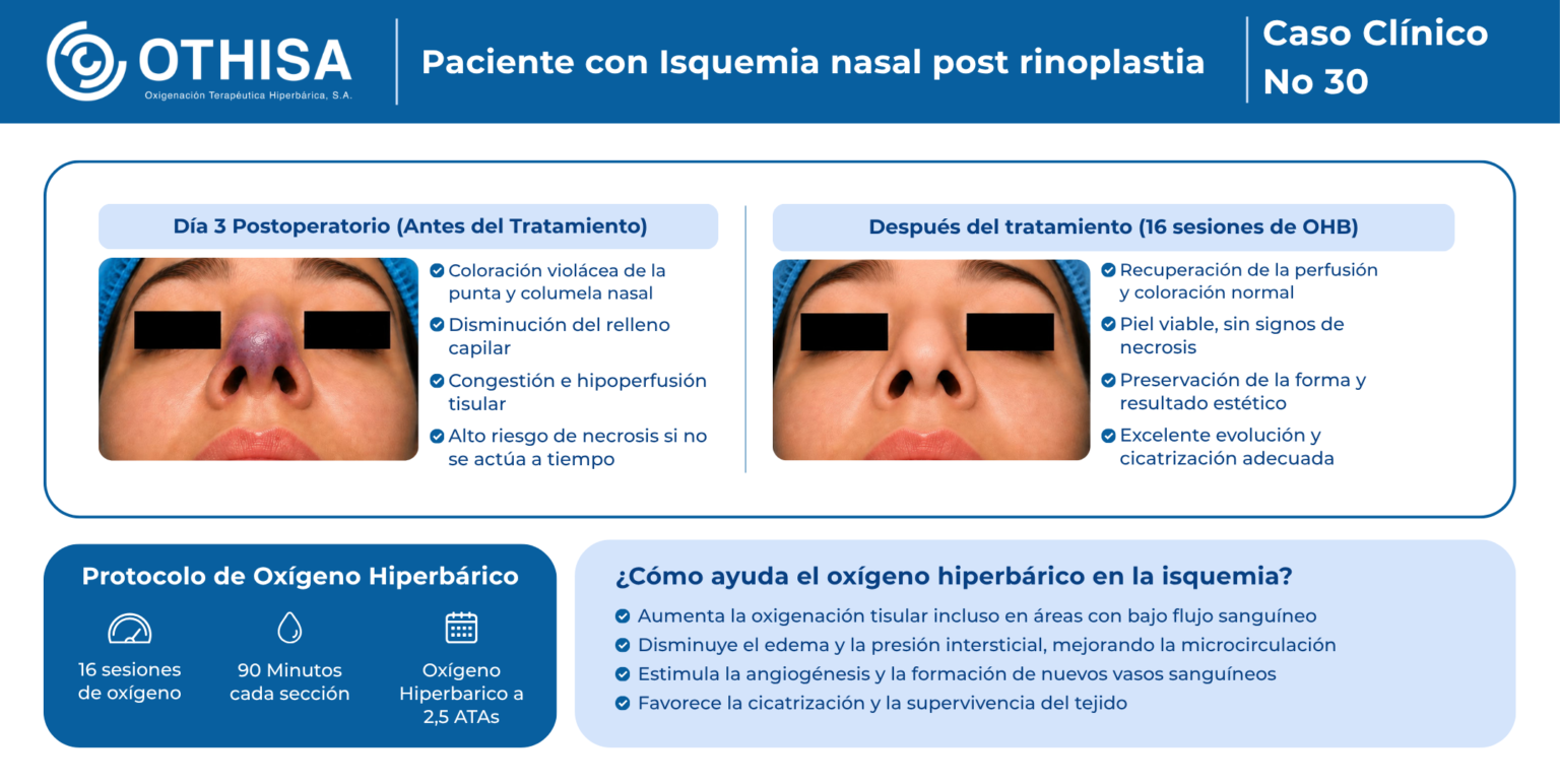Caso Clínico 30 Paciente con Isquemia nasal post rinoplastia