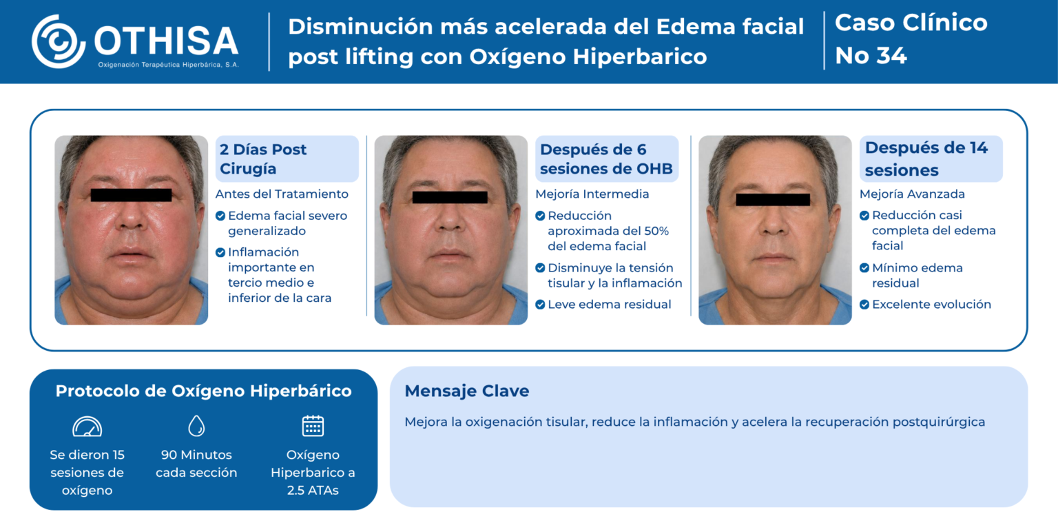 Caso Clínico 34 Disminución más acelerada del Edema facial post lifting con Oxígeno Hiperbarico